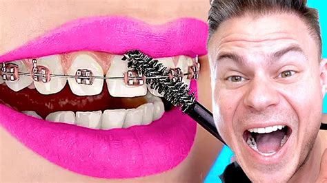 Braces Gone Wrong .